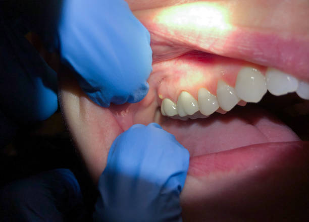 Best Dental Abscess Treatment in Columbiana, AL